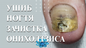 Аппаратный педикюр, когда у клиента ушиб пальца на ноге.