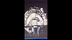 Сканирование и моделирование модели для фрезерования циркониевой коронки