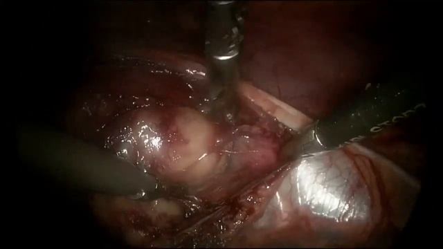 Псевдоопухоль средостения.mp4