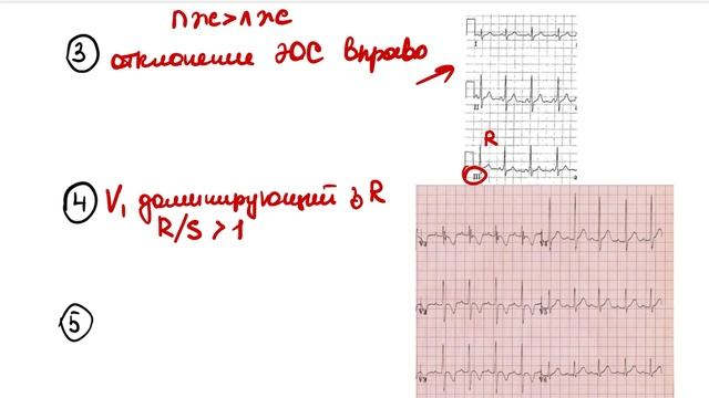 ЭКГ У ДЕТЕЙ. Особенности анализа ЭКГ. Отличие от взрослой ЭКГ.