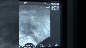 Пункция кисты яичника