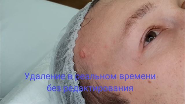 Удаление РОДИНКИ. смотреть онлайн