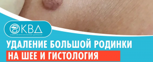 ✅ Удаление большой родинки на шее и гистология. Клинический случай №737