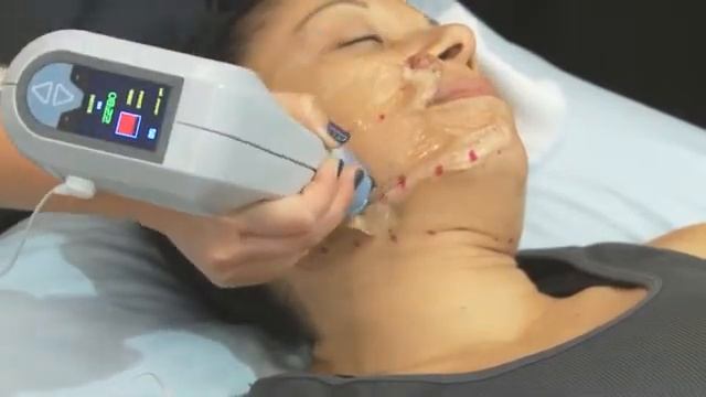 Exilis Treatment Procedure смотреть онлайн