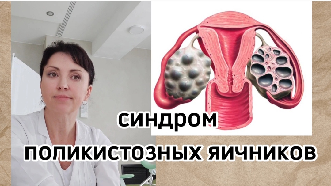 Синдром поликистозных яичников