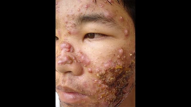 Самые прыщавые люди - прыщи и угри на лице и теле