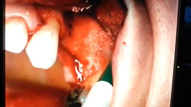 Sinus Lift using DASK system by Michael Tang смотреть онлайн