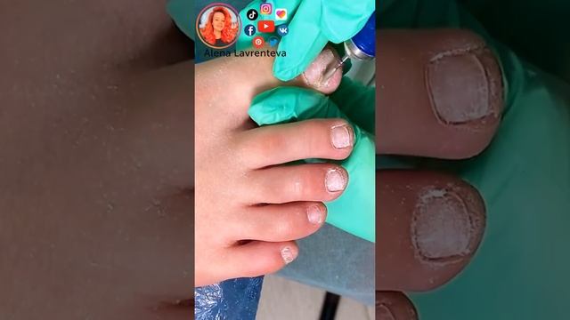 Зелёный ноготь? синегнойная палочка? смотреть онлайн