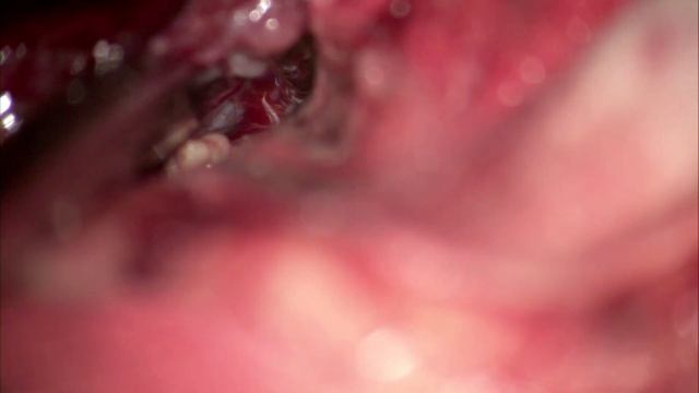 Etude 10. Planum sphenoidale meningioma смотреть онлайн