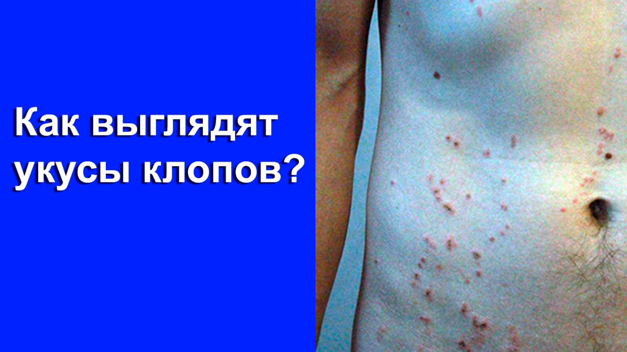 Как выглядят укусы клопов? смотреть онлайн