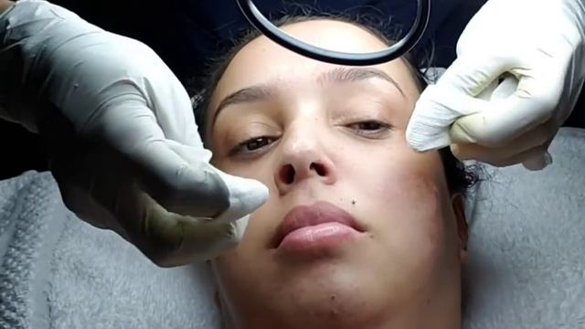 derma renew peel experience تحضير البشرة للتقشير العميق смотреть онлайн