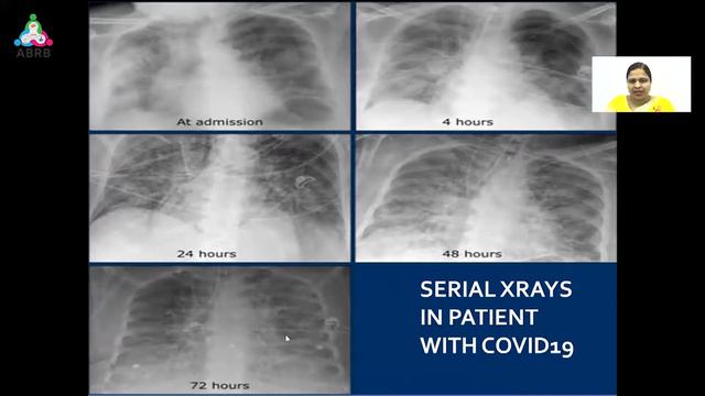 Covid Imaging Findings X ray & CT смотреть онлайн