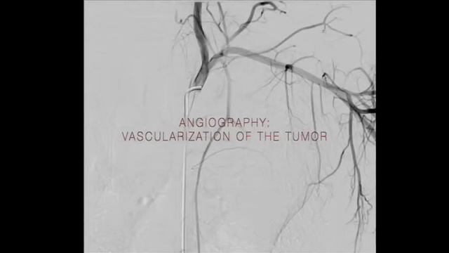 Mediastinal Hemangioma смотреть онлайн