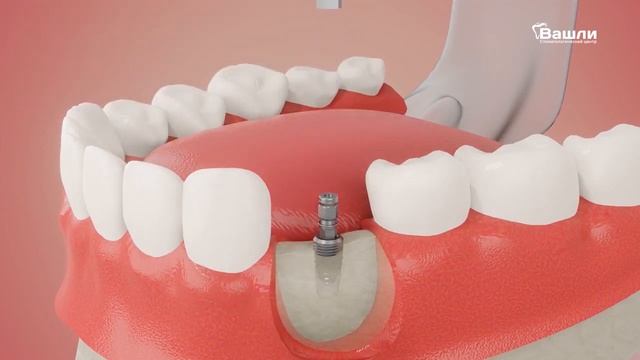 Имплантация зубов: этапы установки имплантата, фдм, абатмента, коронки смотреть онлайн