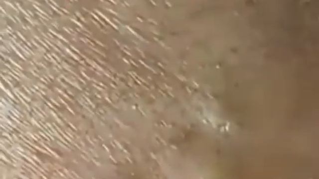 Выдавливание угрей. смотреть онлайн