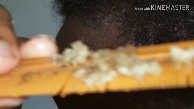 Huge hand full of flakes !!!!!!!! Part 2 SCRATCHING MY SCALP смотреть онлайн