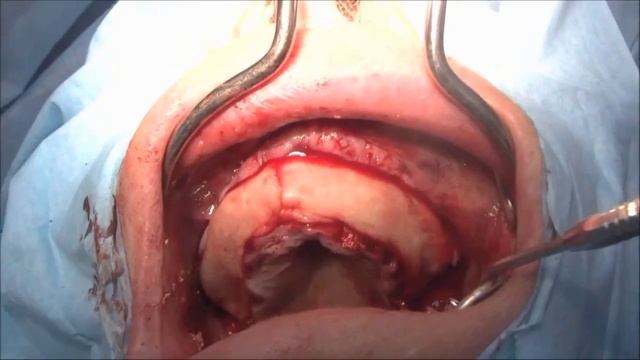 I-PRF  и JASON FLEECE