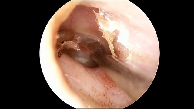 Шунтирование барабанной перепонки. смотреть онлайн