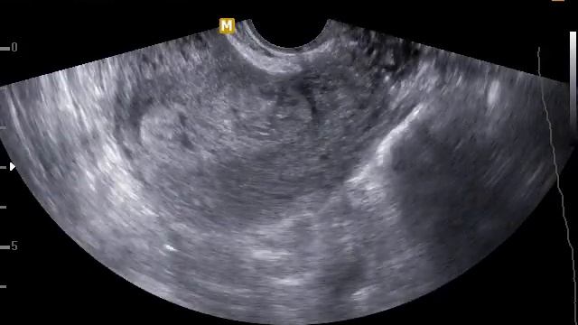 Беременность 5-6 недель в рубце на матке после кесарева сечения. смотреть онлайн