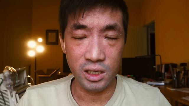 STOPPED DUPIXENT For 3 Months. How Long Dupilumab Keep Skin Clear Of Eczema? Side Effects | Ep.123