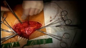 Вентральная грыжа