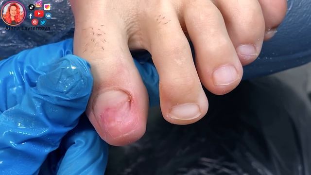Онихолизис ногтей / Как выбрать носки по размеру смотреть онлайн