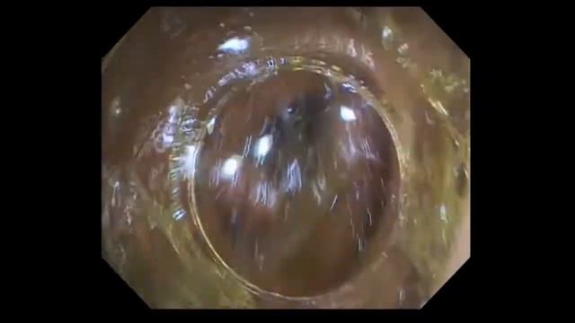 Дивертикулярная болезнь. Инверсия дивертикула. Контрольное исследование после полипэктомии. смотреть онлайн