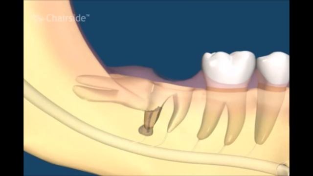 Что делать если болит зуб мудрости. Лечение воспаления зуба мудрости. Хирургическая стоматология. смотреть онлайн