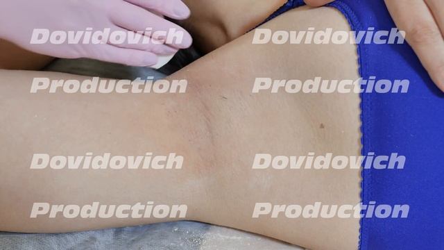 Depilation of armpits with sugar paste. Shugaring. смотреть онлайн