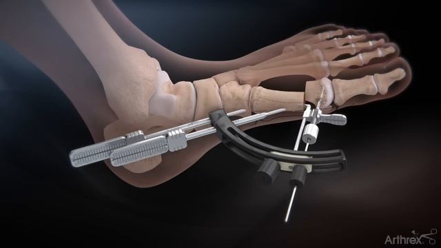 Arthrex Minimally Invasive Bunionectomy System Surgical Technique