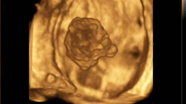 Опухоль мочевого пузыря(28-11-17)