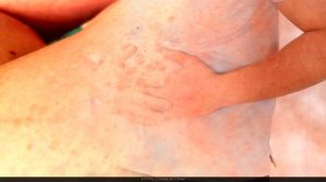 Что такое менингит?