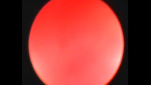 Гистероскопия.Полип эндометрия.Выскабливание полости матки. смотреть онлайн