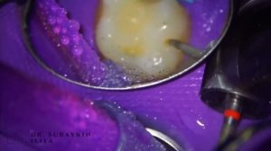 Реставрация зуба , постановка пломбы на зуб , композитная пломба #стоматология #кариес #пломба