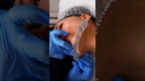 Армирование субмандилярной зоны нитями моно