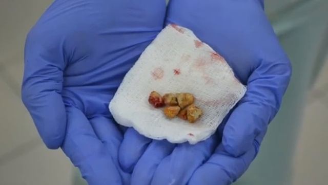 КАМНИ В ПОЧКАХ - Причины, профилактика и лечение / Мочекаменная болезнь смотреть онлайн