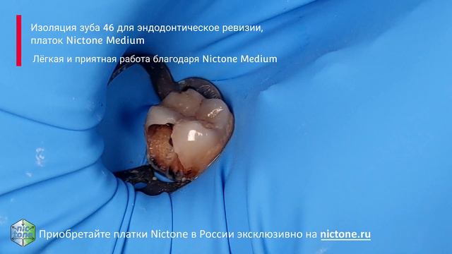 Изоляция зуба 26 для эндодонтическое ревизии, платок Nictone Medium 4K