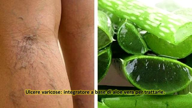 Ulcere varicose: integratore a base di aloe vera per trattarle смотреть онлайн