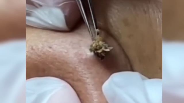 Dpow | Giant Blackhead Extraction I Giant Acne #blackheads #pimple #removal Dilated Pore Of Winer