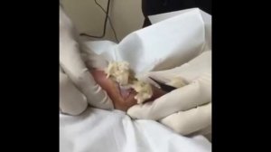 Огромный жировик! Жесть! Acne! Угри! Как избавится от черноголовых