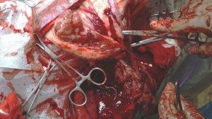 Удаление новообразования на поджелудочной железе.