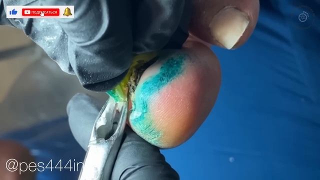 Отдавленный ноготь / отбитый ноготь / оторванный ноготь