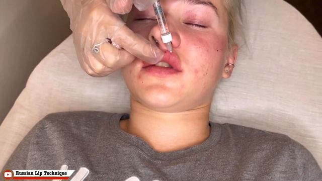 Lips Lifting Up 2022 - Beautiful Lips Using Russian Lip Technique