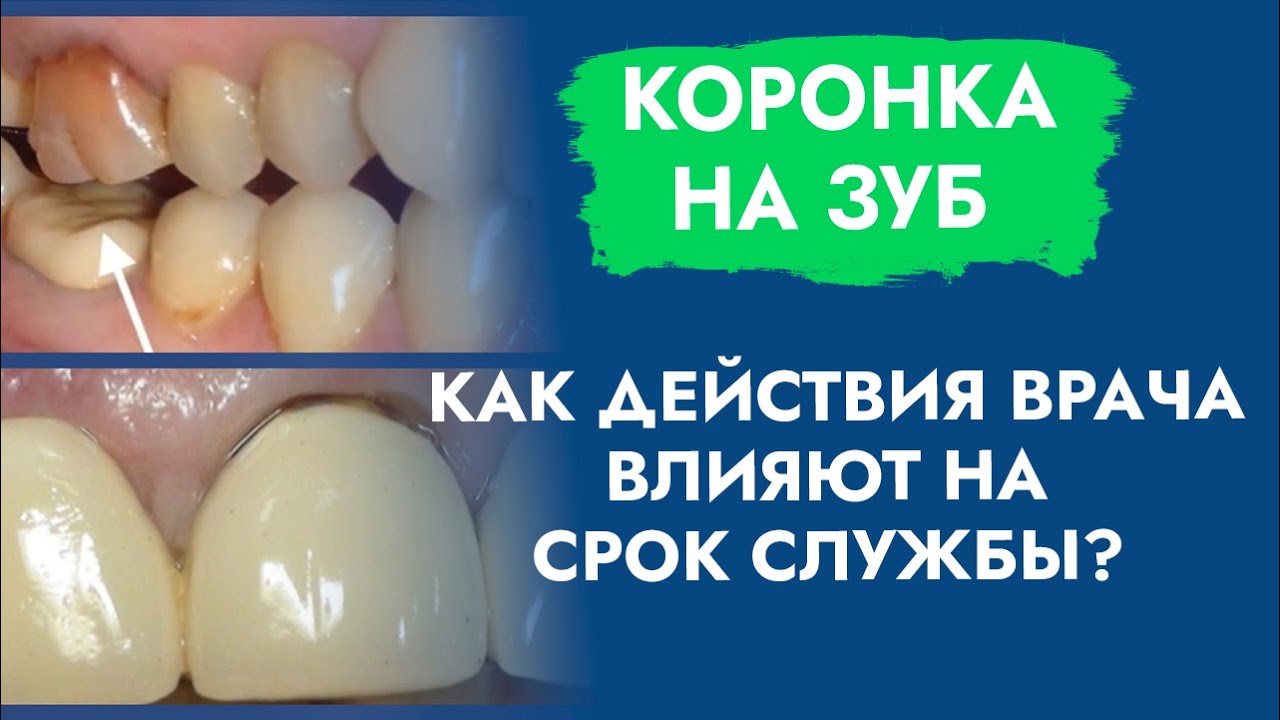Коронка на зуб. Как действия врача влияют на срок службы? смотреть онлайн