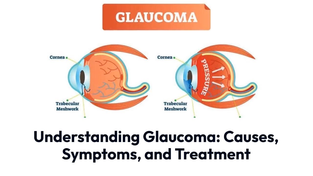 Understanding Glaucoma_ Causes, Symptoms, And Treatment