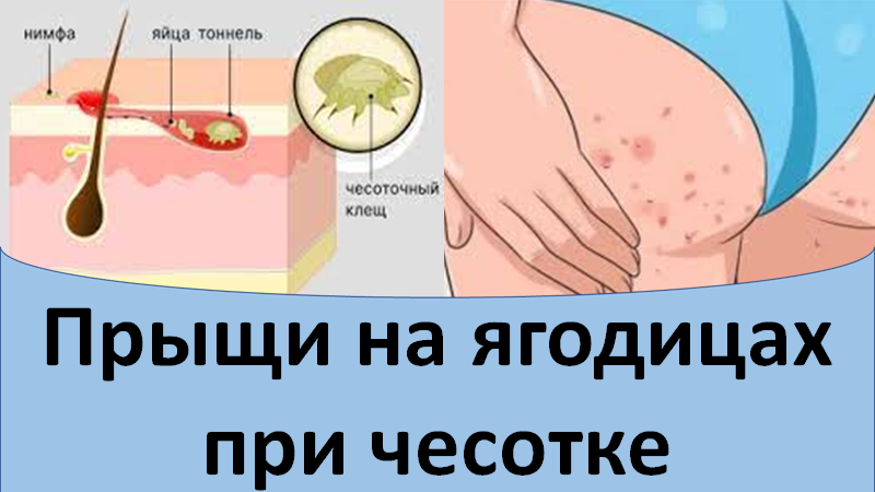 Прыщи на ягодицах при чесотке смотреть онлайн