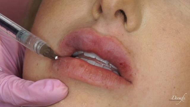 Lip Filler on BOTOX EXPRESS Mobile Botox Bar смотреть онлайн