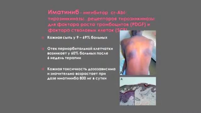 Кожная токсичность современной таргетной терапии смотреть онлайн