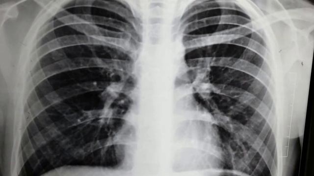Bilateral hilar patch in a child смотреть онлайн