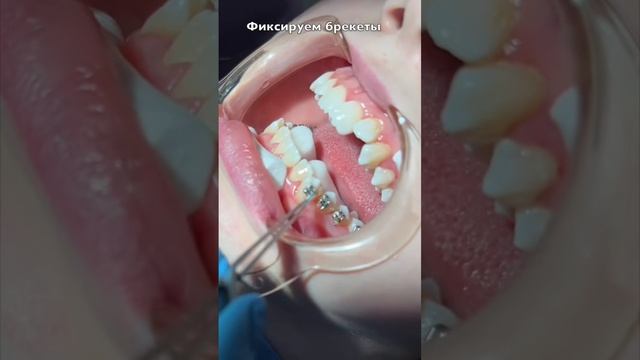 Установка брекетов смотреть онлайн